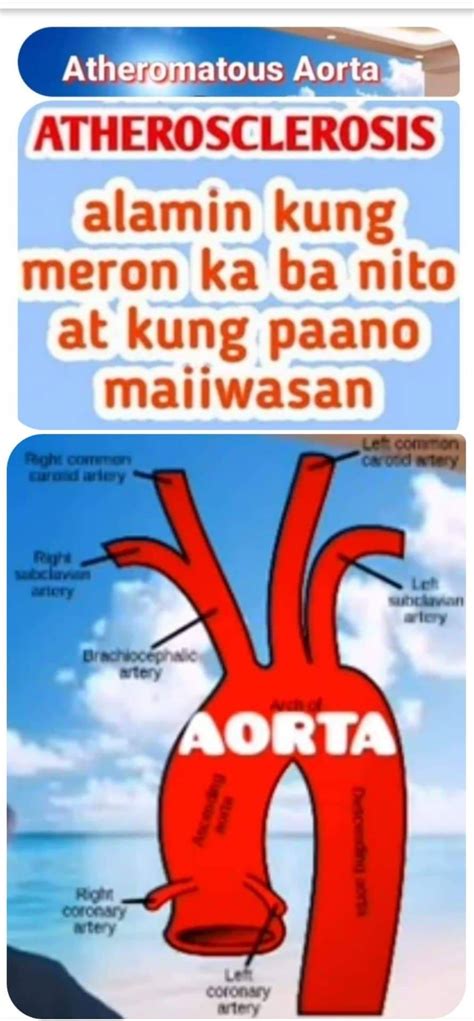 what is atheromatous aorta in tagalog